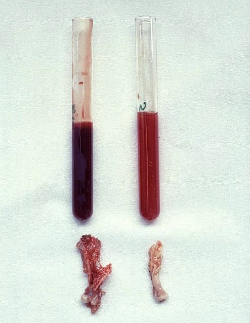 Atrofia da medula óssea e anemia